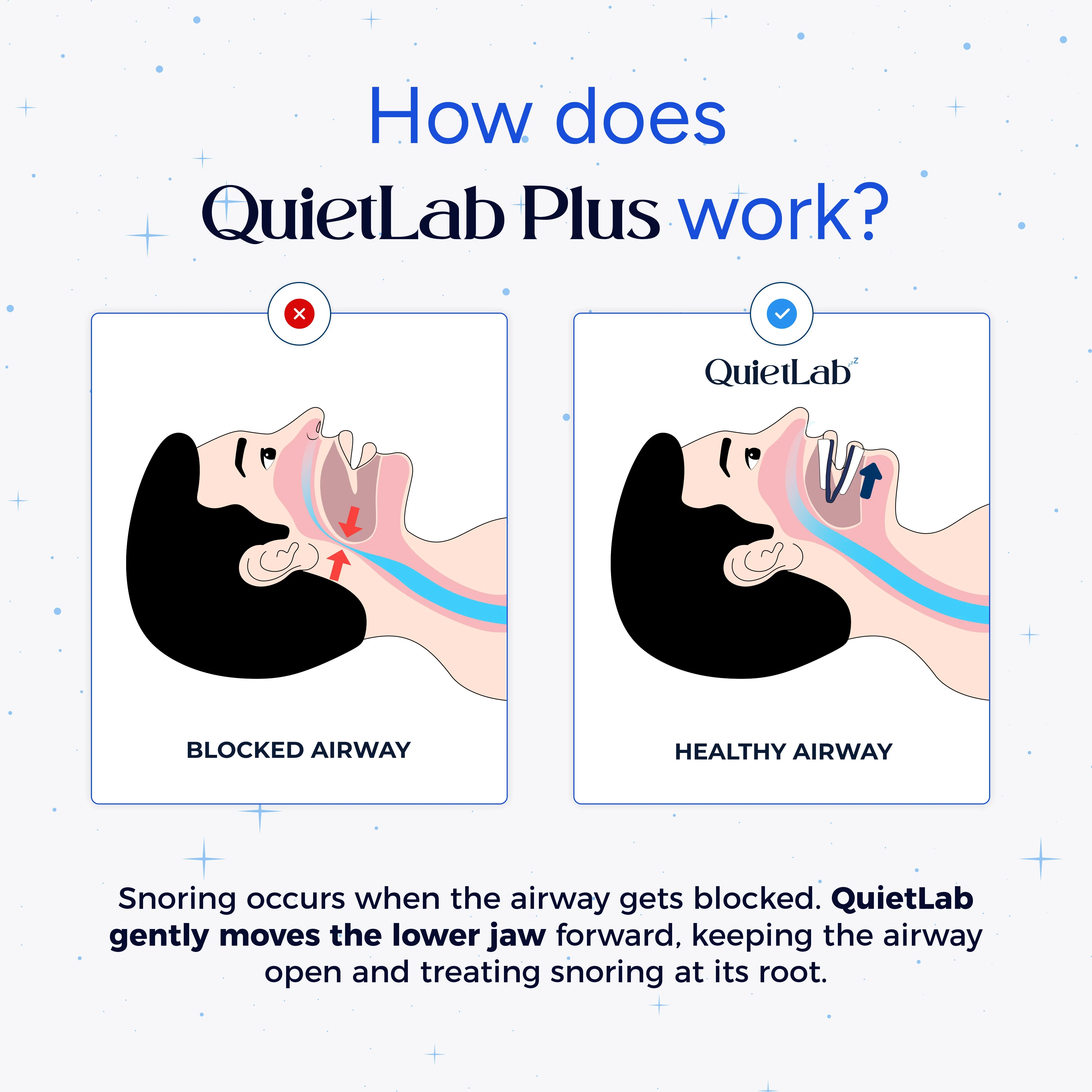 QuietLab® Plus Anti-Snoring Mouthpiece - Image 5